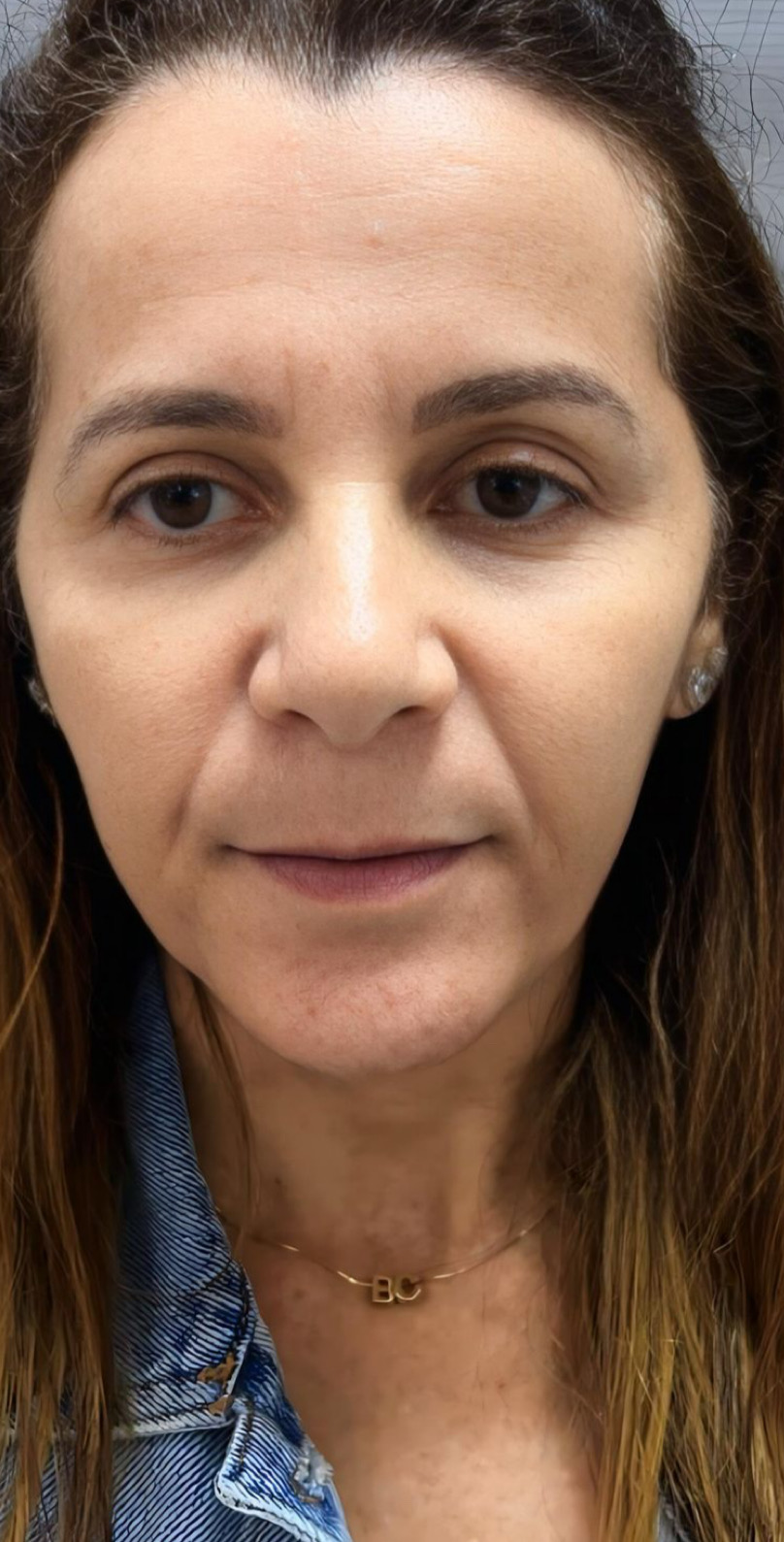 Antes - resultado cicatrizado