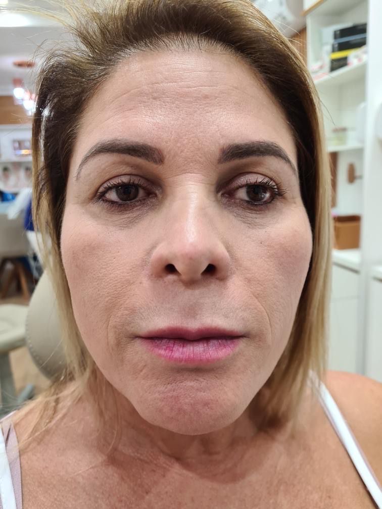 Antes - resultado cicatrizado
