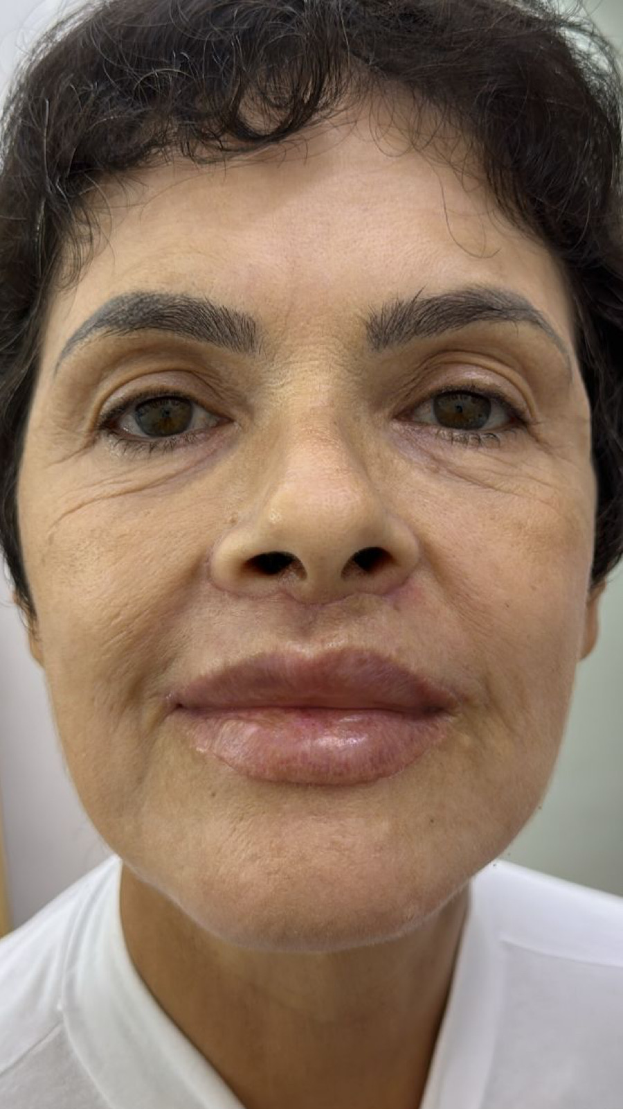 Depois - resultado cicatrizado