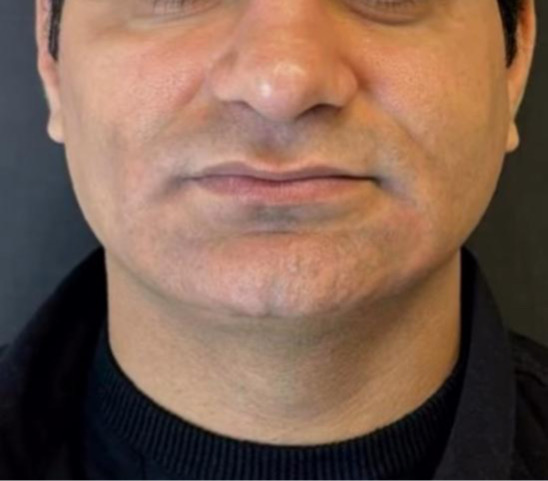 Antes - resultado cicatrizado